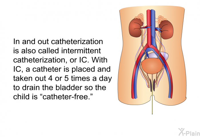 In and out catheterization is also called intermittent catheterization, or IC. With IC, a catheter is placed and taken out 4 or 5 times a day to drain the bladder so the child is “catheter-free.”