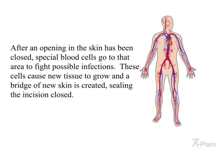 After an opening in the skin has been closed, special blood cells go to that area to fight possible infections. These cells cause new tissue to grow and a bridge of new skin is created, sealing the incision closed.