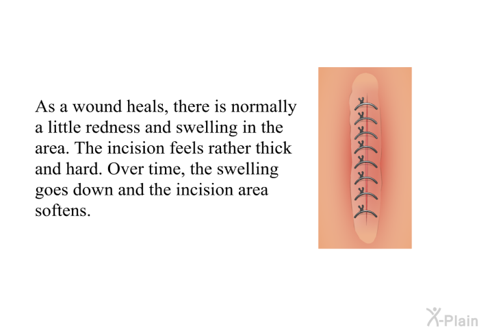 As a wound heals, there is normally a little redness and swelling in the area. The incision feels rather thick and hard. Over time, the swelling goes down and the incision area softens.