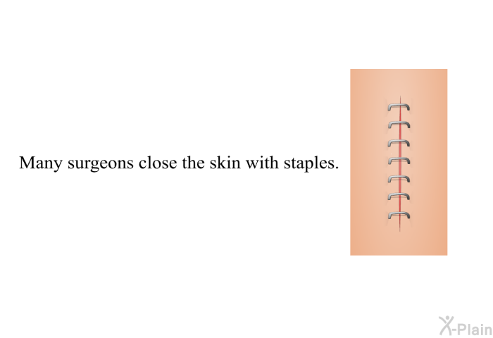 Many surgeons close the skin with staples.
