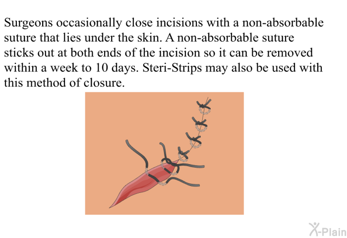 Surgeons occasionally close incisions with a non-absorbable suture that lies under the skin. A non-absorbable suture sticks out at both ends of the incision so it can be removed within a week to 10 days. Steri-Strips may also be used with this method of closure.