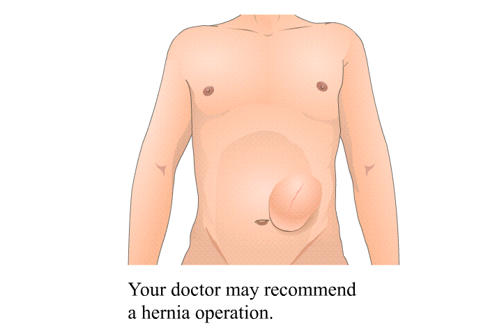Your doctor may recommend a hernia operation.