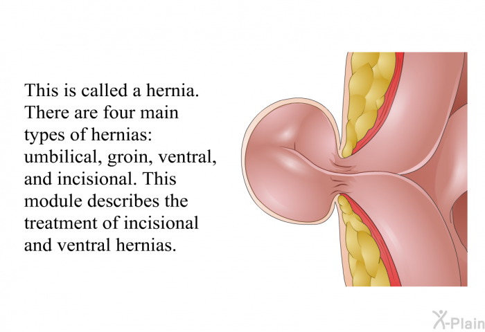 This is called a hernia. There are four main types of hernias: umbilical, groin, ventral and incisional. This module describes the treatment of incisional and ventral hernias.