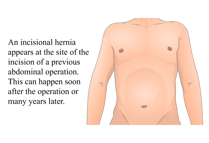 An incisional hernia appears at the site of the incision of a previous abdominal operation. This can happen soon after the operation or many years later.