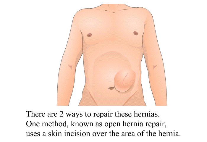 There are 2 ways to repair these hernias. One method, known as open hernia repair, uses a skin incision over the area of the hernia.