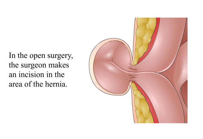 In the open surgery, the surgeon makes an incision in the area of the hernia.
