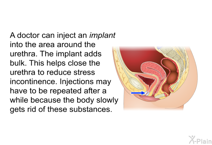 A doctor can inject an implant into the area around the urethra. The implant adds bulk. This helps close the urethra to reduce stress incontinence. Injections may have to be repeated after a while because the body slowly gets rid of these substances.