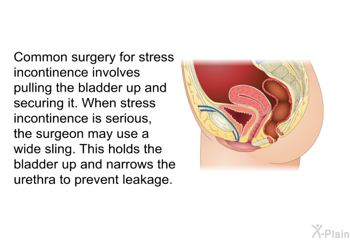 Common surgery for stress incontinence involves pulling the bladder up and securing it. When stress incontinence is serious, the surgeon may use a wide sling. This holds the bladder up and narrows the urethra to prevent leakage.
