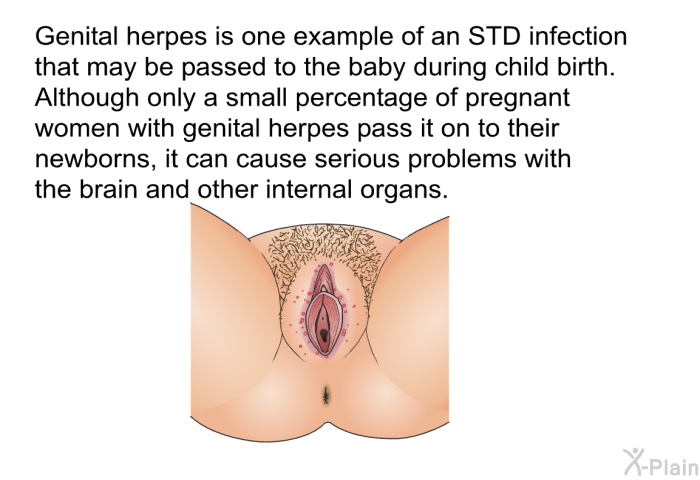 Genital herpes is one example of an STD infection that may be passed to the baby during child birth. Although only a small percentage of pregnant women with genital herpes pass it on to their newborns, it can cause serious problems with the brain and other internal organs.