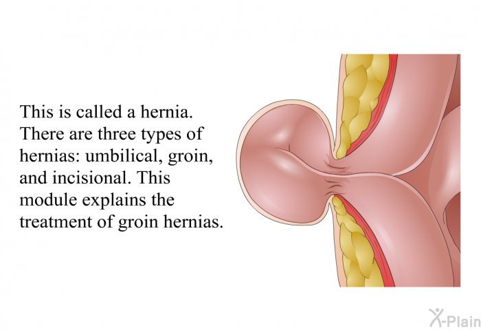 This is called a hernia. There are three types of hernias: umbilical, groin, and incisional. This module explains the treatment of groin hernias.