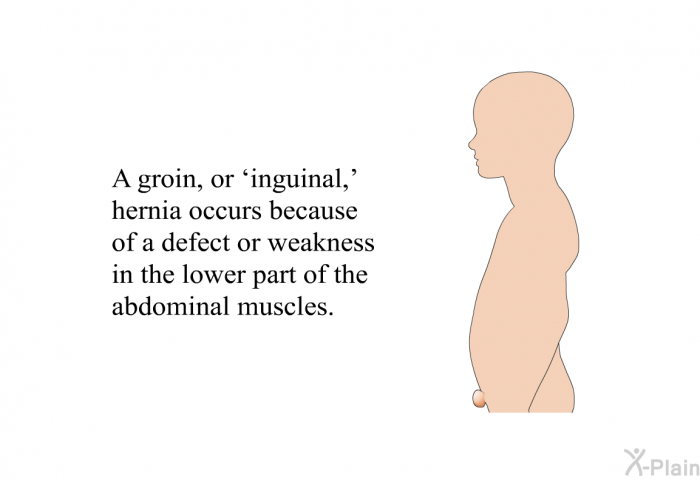 A groin, or  inguinal,' hernia occurs because of a defect or weakness in the lower part of the abdominal muscles.
