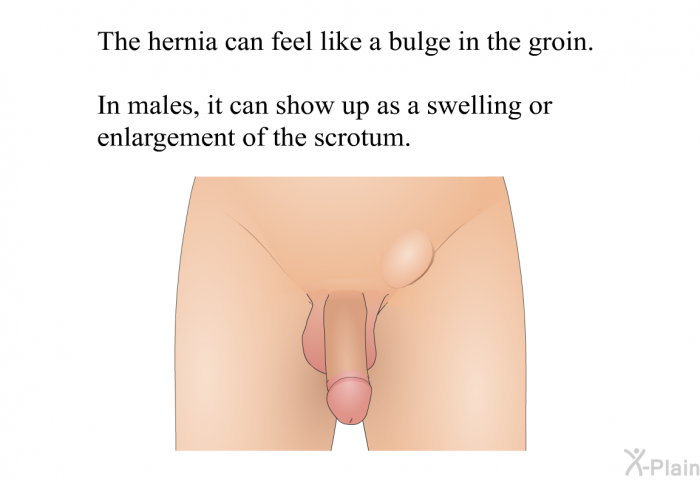 The hernia can feel like a bulge in the groin. In males, it can show up as a swelling or enlargement of the scrotum.