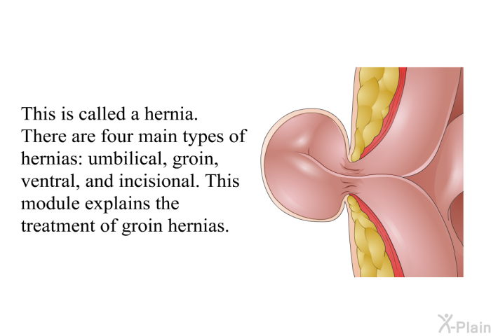 This is called a hernia. There are four main types of hernias: umbilical, groin, ventral, and incisional. This module explains the treatment of groin hernias.