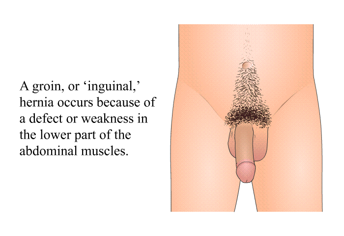 A groin, or <I>inguinal</I>, hernia occurs because of a defect or weakness in the lower part of the abdominal muscles.