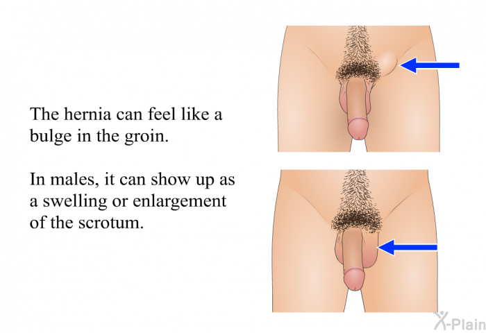 The hernia can feel like a bulge in the groin. In males, it can show up as a swelling or enlargement of the scrotum.