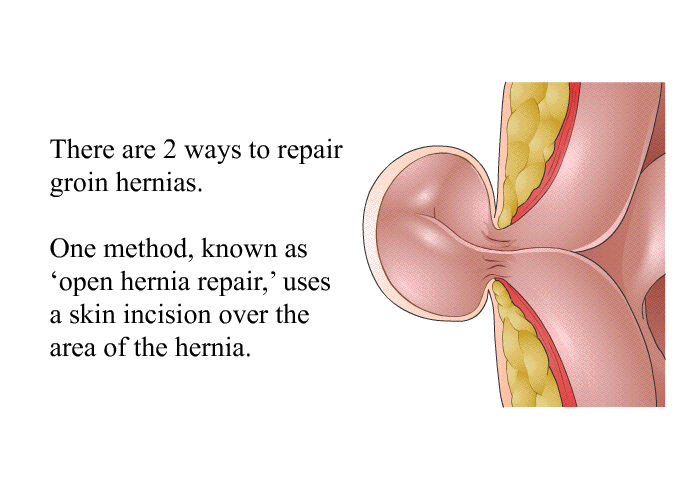 There are 2 ways to repair groin hernias. One method, known as open hernia repair, uses a skin incision over the area of the hernia.