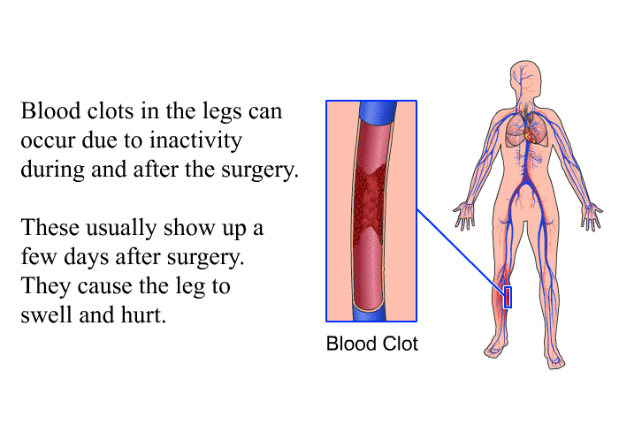 Blood clots in the legs can occur due to inactivity during and after the surgery. These usually show up a few days after surgery. They cause the leg to swell and hurt.