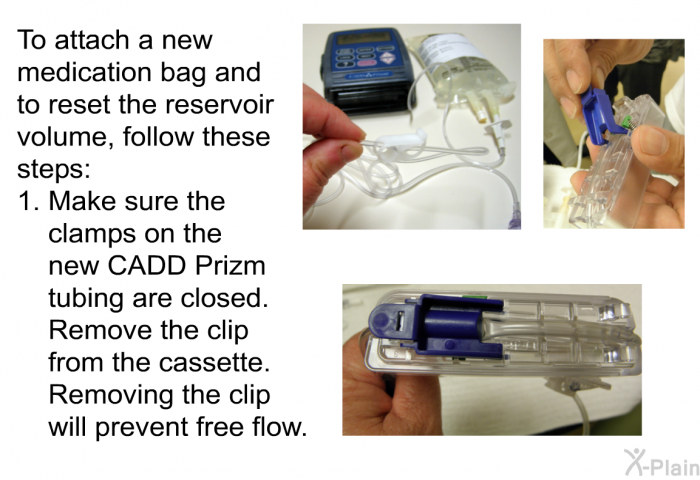 To attach a new medication bag and to reset the reservoir volume, follow these steps:  Make sure the clamps on the new CADD Prizm tubing are closed. Remove the clip from the cassette. Removing the clip will prevent free flow.