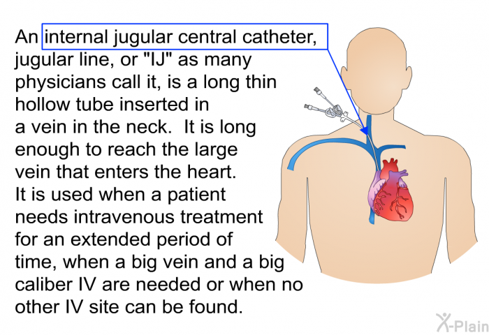 An internal jugular central catheter, jugular line, or “IJ” as many physicians call it, is a long thin hollow tube inserted in a vein in the neck. It is long enough to reach the large vein that enters the heart. It is used when a patient needs intravenous treatment for an extended period of time, when a big vein and a big caliber IV are needed or when no other IV site can be found.