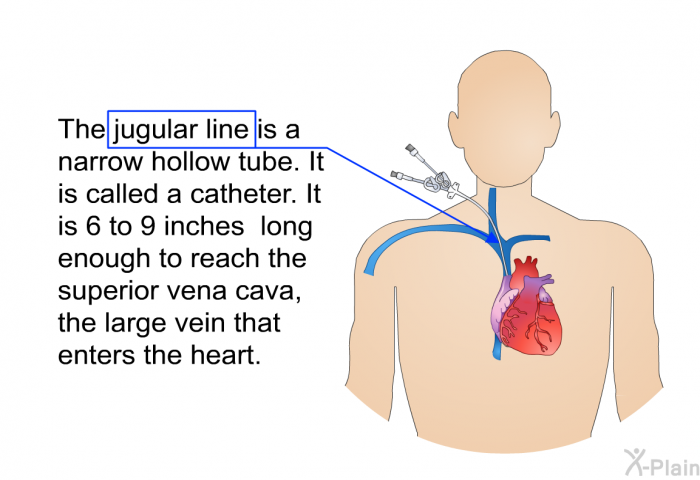 The jugular line is a narrow hollow tube. It is called a catheter. It is 6 to 9 inches long enough to reach the superior vena cava, the large vein that enters the heart.