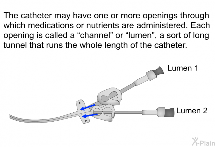 The catheter may have one or more openings through which medications or nutrients are administered. Each opening is called a “channel” or “lumen”, a sort of long tunnel that runs the whole length of the catheter.