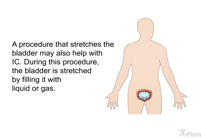A procedure that stretches the bladder may also help with IC. During this procedure, the bladder is stretched by filling it with liquid or gas.