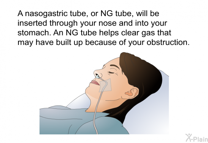 A nasogastric tube, or NG tube, will be inserted through your nose and into your stomach. An NG tube helps clear gas that may have built up because of your obstruction.