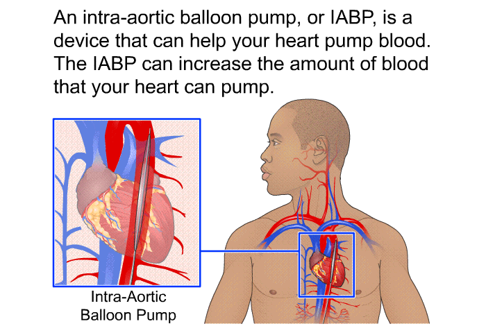 An intra-aortic balloon pump, or IABP, is a device that can help your heart pump blood. The IABP can increase the amount of blood that your heart can pump.