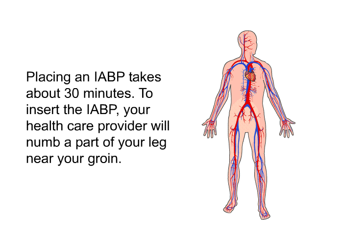 Placing an IABP takes about 30 minutes. To insert the IABP, your health care provider will numb a part of your leg near your groin.