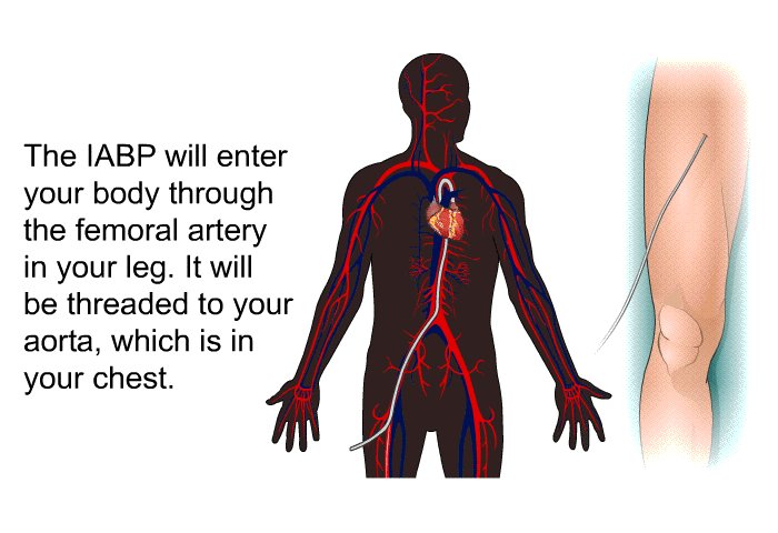 The IABP will enter your body through the femoral artery in your leg. It will be threaded to your aorta, which is in your chest.