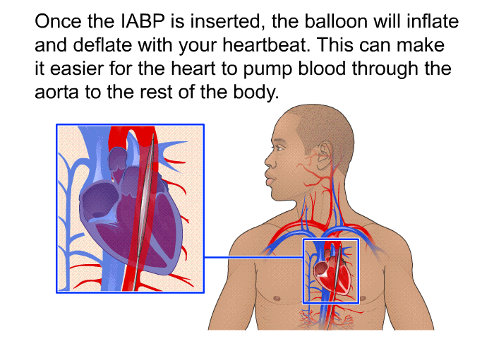 Once the IABP is inserted, the balloon will inflate and deflate with your heartbeat. This can make it easier for the heart to pump blood through the aorta to the rest of the body.