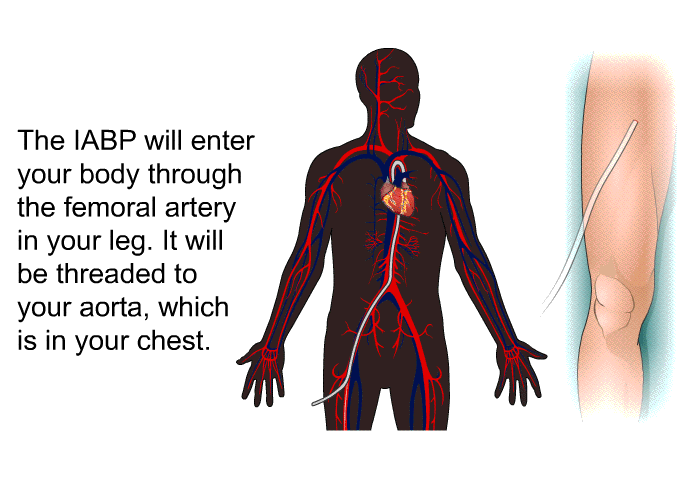 The IABP will enter your body through the femoral artery in your leg. It will be threaded to your aorta, which is in your chest.