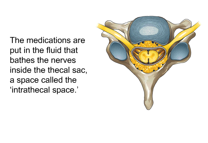 The medications are put in the fluid that bathes the nerves inside the thecal sac, a space called the  intrathecal space.'