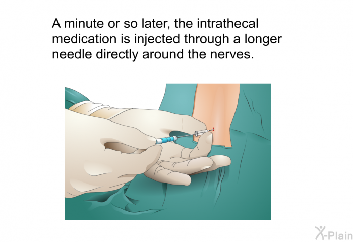 A minute or so later, the intrathecal medication is injected through a longer needle directly around the nerves.