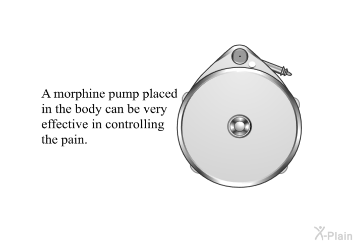 A morphine pump placed in the body can be very effective in controlling the pain.