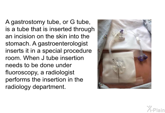 A gastrostomy tube, or G tube, is a tube that is inserted through an incision on the skin into the stomach. A gastroenterologist inserts it in a special procedure room. When J tube insertion needs to be done under fluoroscopy, a radiologist performs the insertion in the radiology department.
