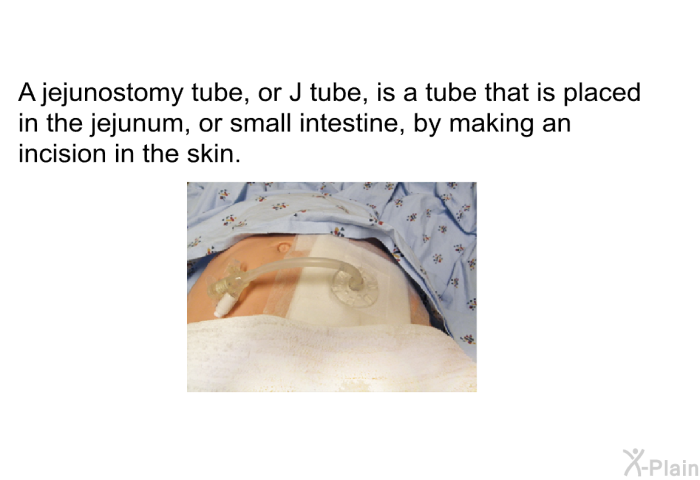 A jejunostomy tube, or J tube, is a tube that is placed in the jejunum, or small intestine, by making an incision in the skin.