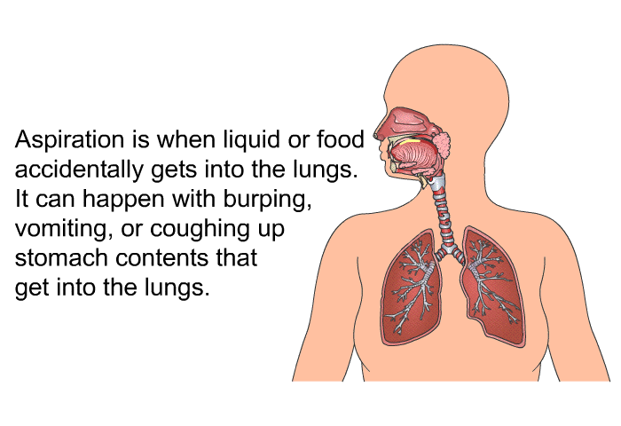 Aspiration is when liquid or food accidentally gets into the lungs. It can happen with burping, vomiting, or coughing up stomach contents that get into the lungs.