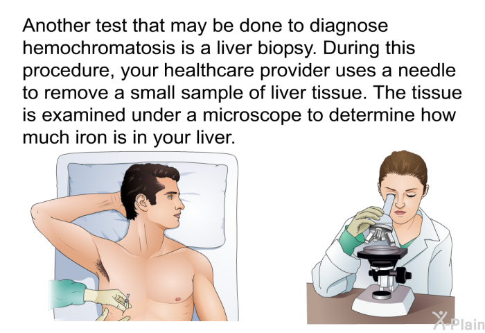 Another test that may be done to diagnose hemochromatosis is a liver biopsy. During this procedure, your healthcare provider uses a needle to remove a small sample of liver tissue. The tissue is examined under a microscope to determine how much iron is in your liver.