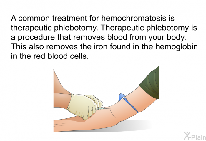 A common treatment for hemochromatosis is therapeutic phlebotomy. Therapeutic phlebotomy is a procedure that removes blood from your body. This also removes the iron found in the hemoglobin in the red blood cells.
