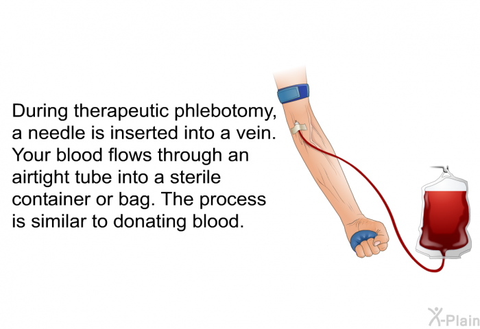 During therapeutic phlebotomy, a needle is inserted into a vein. Your blood flows through an airtight tube into a sterile container or bag. The process is similar to donating blood.