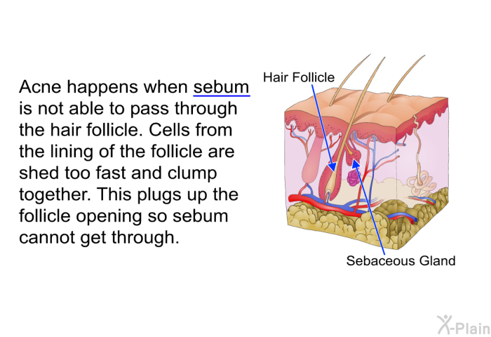 Acne happens when sebum is not able to pass through the hair follicle. Cells from the lining of the follicle are shed too fast and clump together. This plugs up the follicle opening so sebum cannot get through.