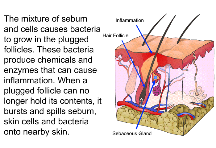 The mixture of sebum and cells causes bacteria to grow in the plugged follicles. These bacteria produce chemicals and enzymes that can cause inflammation. When a plugged follicle can no longer hold its contents, it bursts and spills sebum, skin cells and bacteria onto nearby skin.