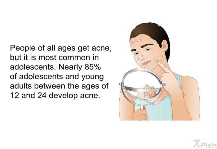 People of all ages get acne, but it is most common in adolescents. Nearly 85% of adolescents and young adults between the ages of 12 and 24 develop acne.
