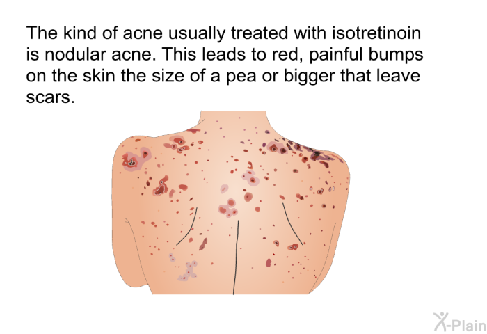 The kind of acne usually treated with isotretinoin is nodular acne. This leads to red, painful bumps on the skin the size of a pea or bigger that leave scars.