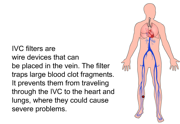IVC filters are wire devices that can be placed in the vein. The filter traps large blood clot fragments. It prevents them from traveling through the IVC to the heart and lungs, where they could cause severe problems.