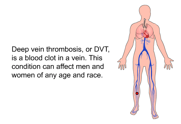 Deep vein thrombosis, or DVT, is a blood clot in a vein. This condition can affect men and women of any age and race.