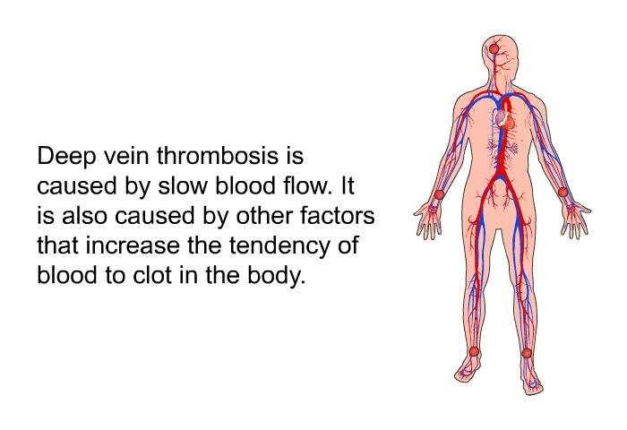 Deep vein thrombosis is caused by slow blood flow. It is also caused by other factors that increase the tendency of blood to clot in the body.