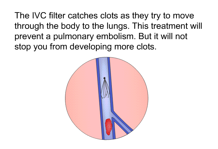 The IVC filter catches clots as they try to move through the body to the lungs. This treatment will prevent a pulmonary embolism. But it will not stop you from developing more clots.