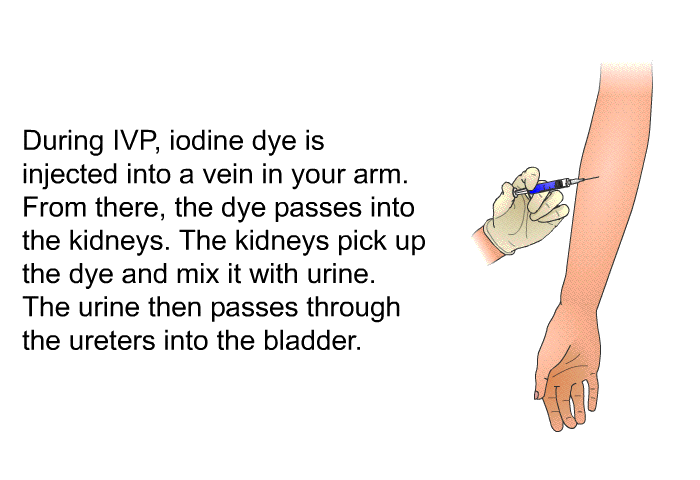 During IVP, iodine dye is injected into a vein in your arm. From there, the dye passes into the kidneys. The kidneys pick up the dye and mix it with urine. The urine then passes through the ureters into the bladder.